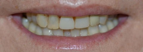 Caso 4: Rejuvenecer una sonrisa.
