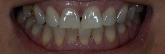 Caso 5: Puentes metal cerámica: Paciente con Tetraciclinas