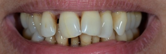 Caso 6: rehabilitación estética de paciente periodontal