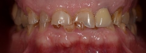 SOLUCIONANDO UN GRAN DESGASTE DENTAL